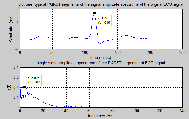 ecg signal matlab code pdf